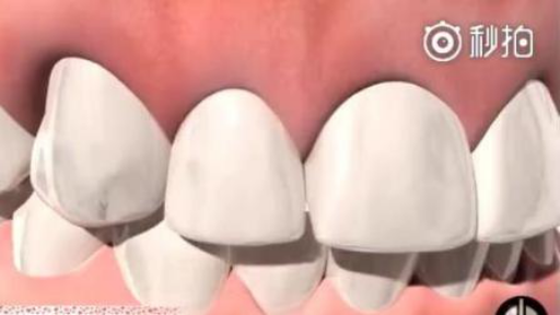 纯钛假牙有几款款式区别,纯钛活动假牙能用几年